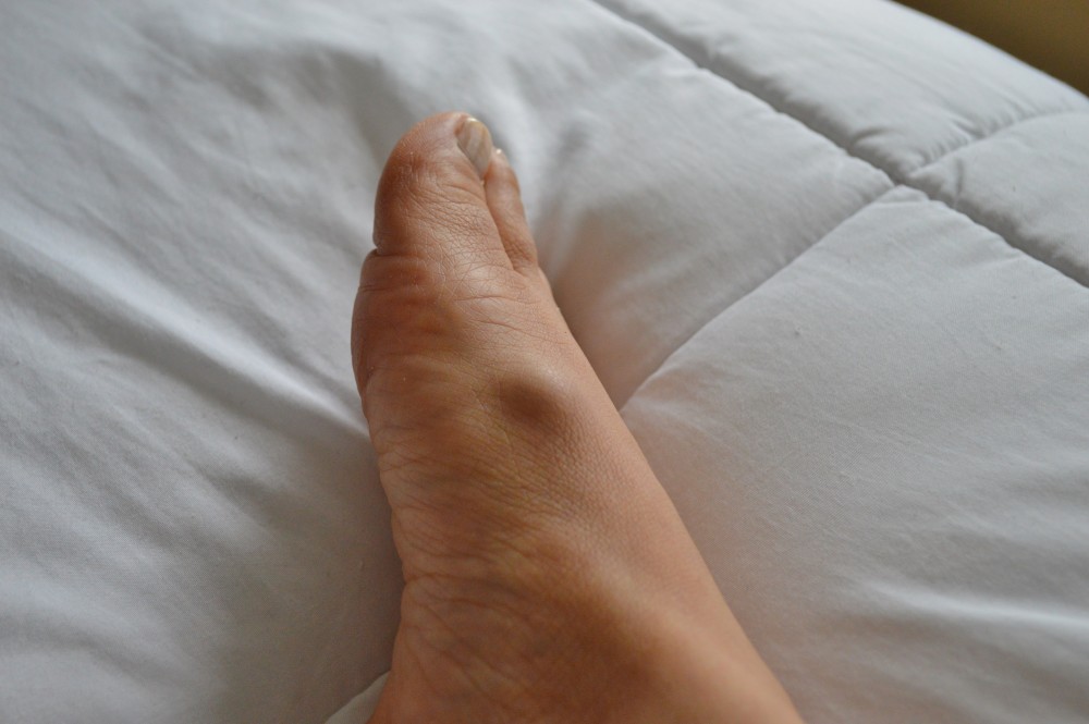 A Podiatrist and Her Ganglion Cyst