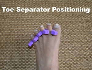 Wear toe separators overnight to help prevent hammertoe deformites