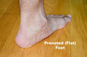 pronated (flat) foot
