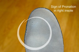 sign of pronation in right shoe insole of a person with a pronated (flat) foot