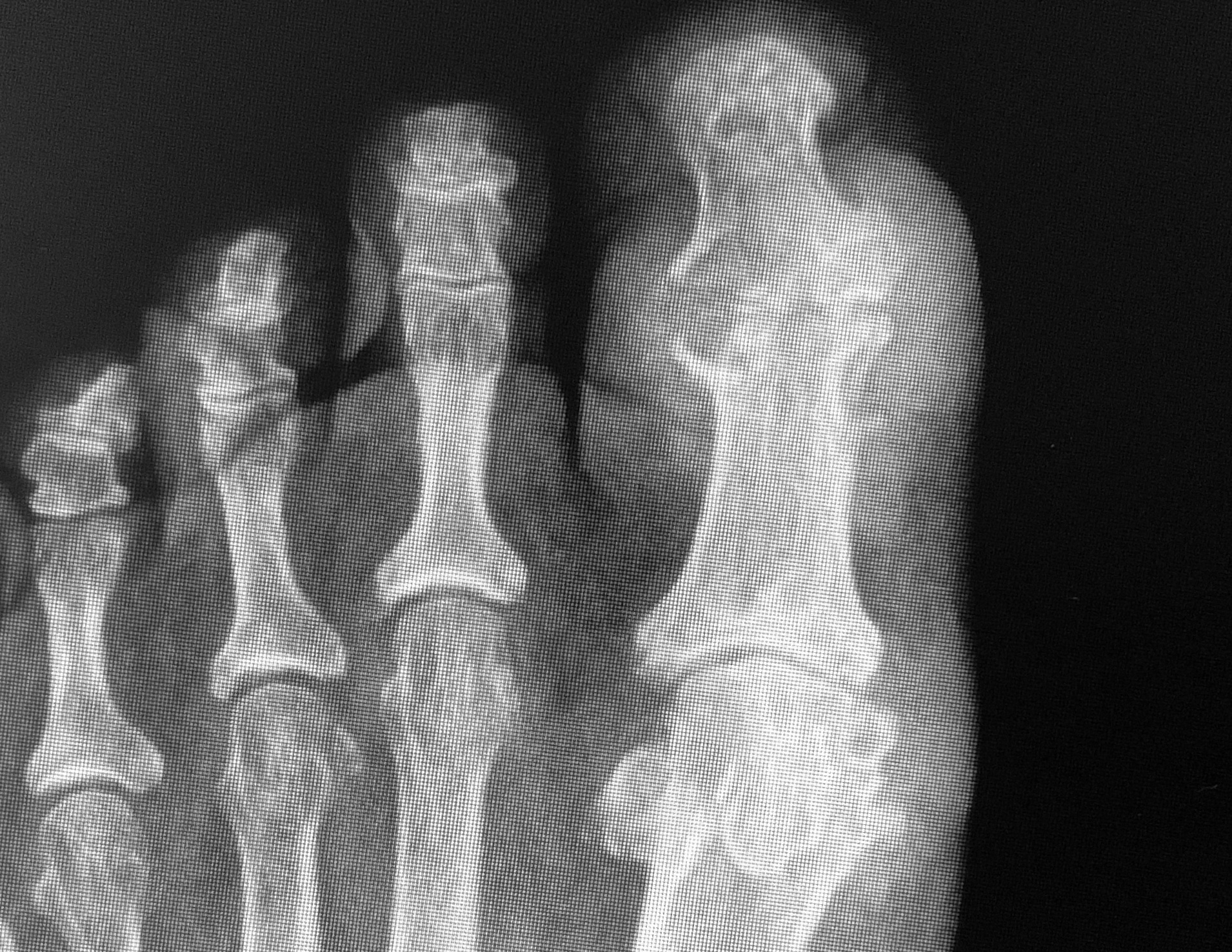 Beware of Gout! Tips to Avoid a Painful Attack