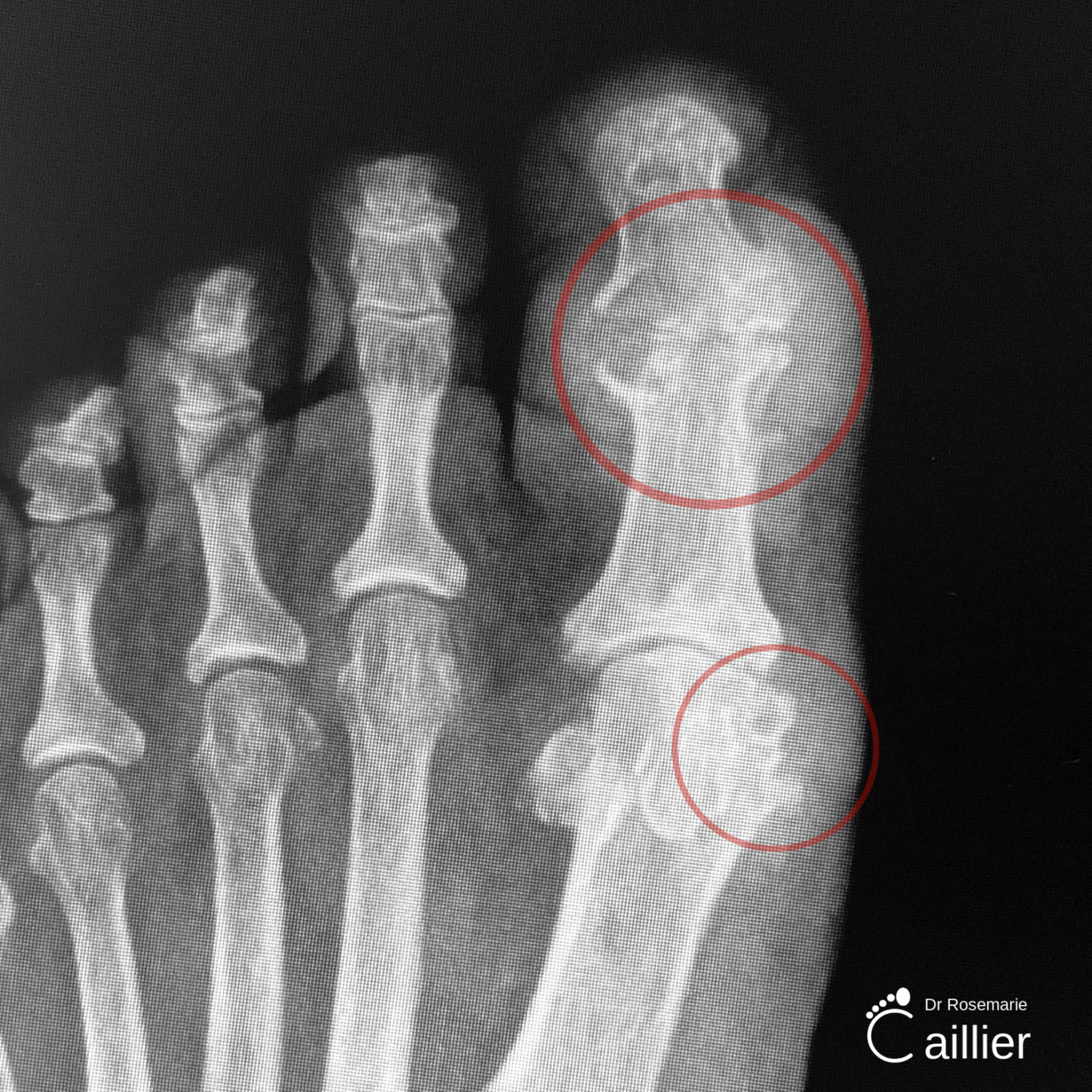 X-Ray Gout Image