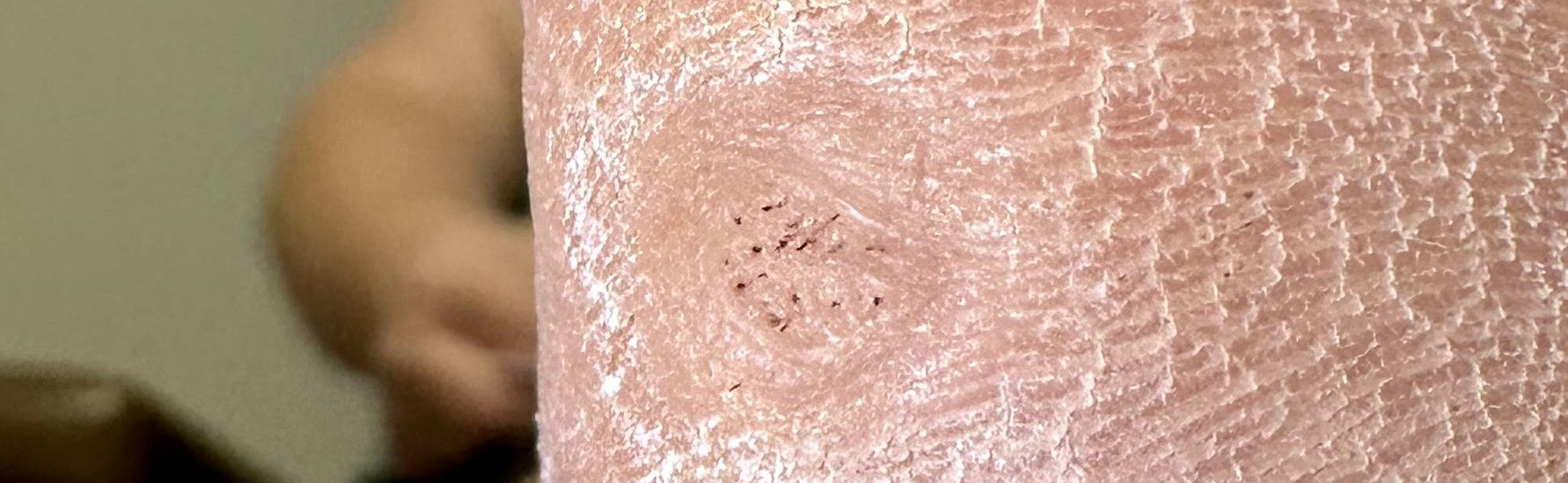 What to do about Plantar Warts