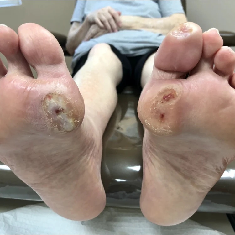 Diabetic Foot Ulcers