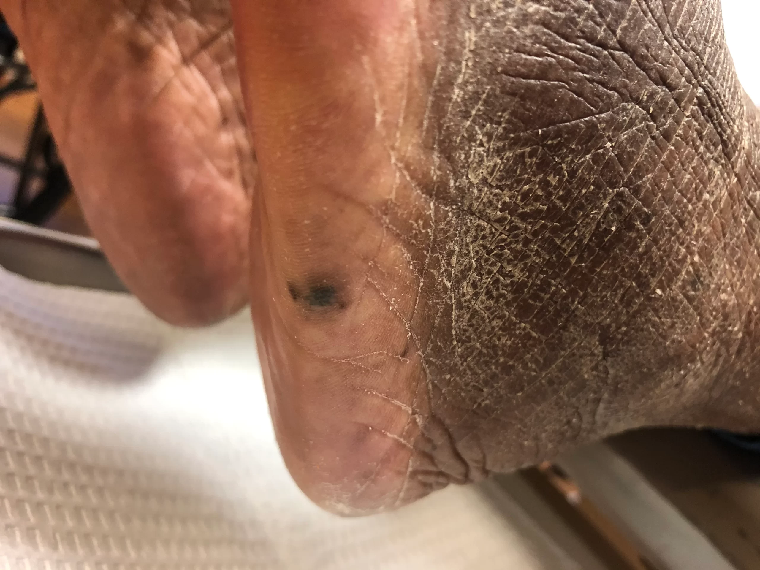 Mole on foot in need of biopsy