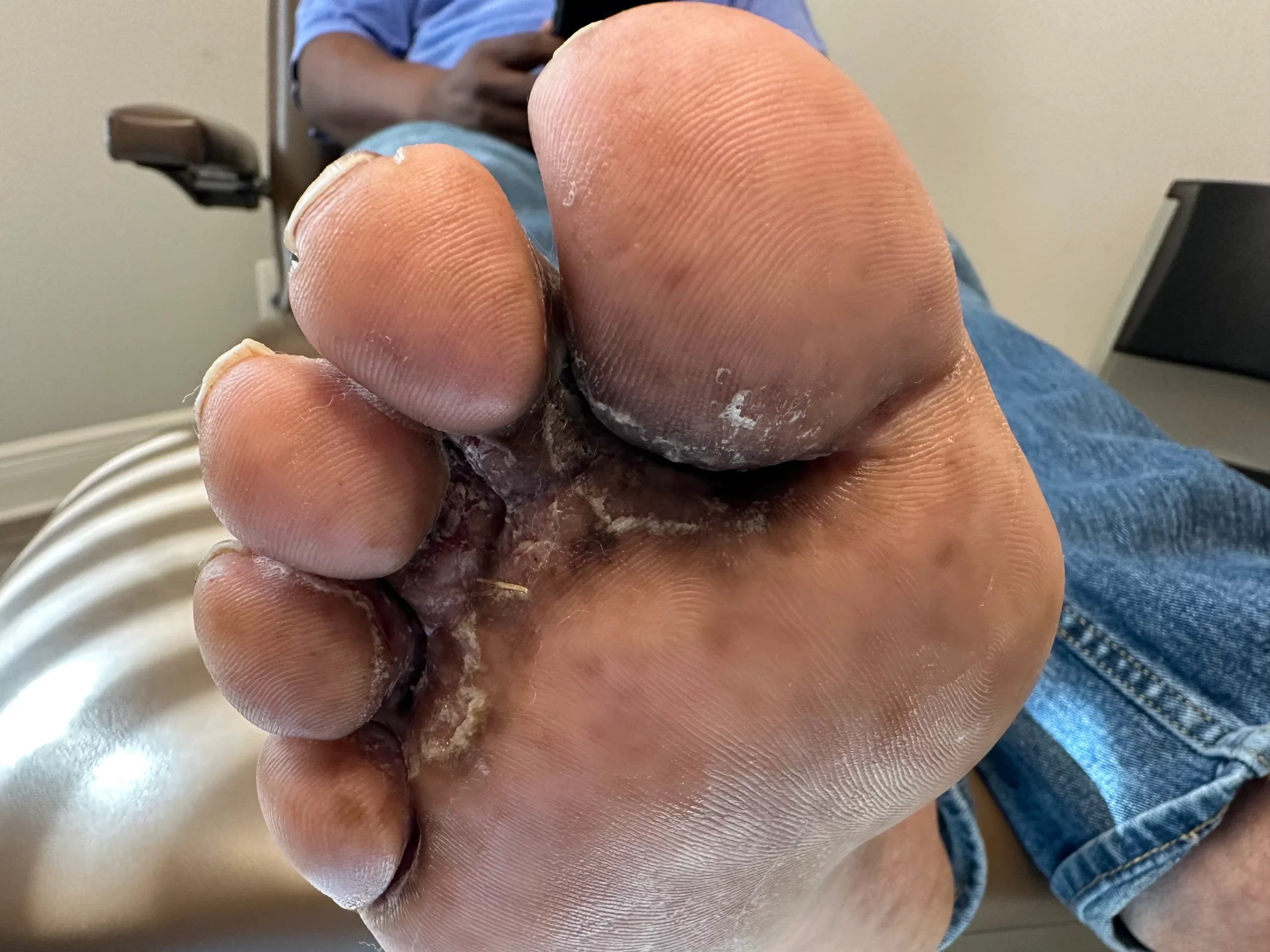 Athlete's foot between toes